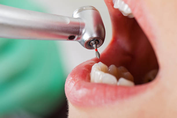 Best Emergency Tooth Extraction in Sutherland, NE